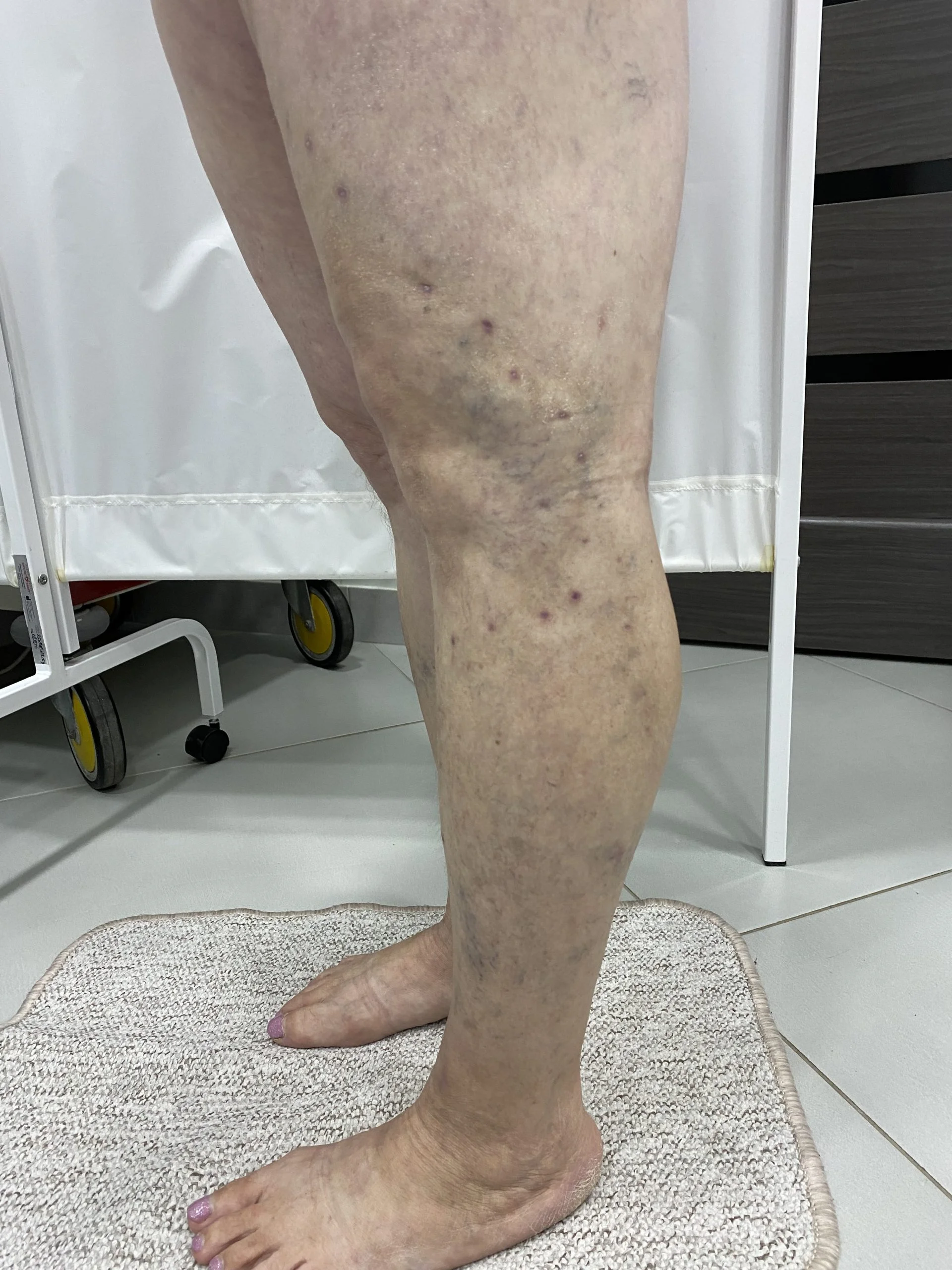 Переваги склеротерапії при лікуванні варикозу - Фото 4