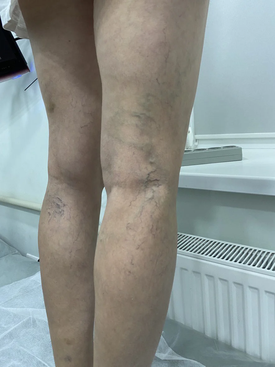 Переваги склеротерапії при лікуванні варикозу - Фото 6