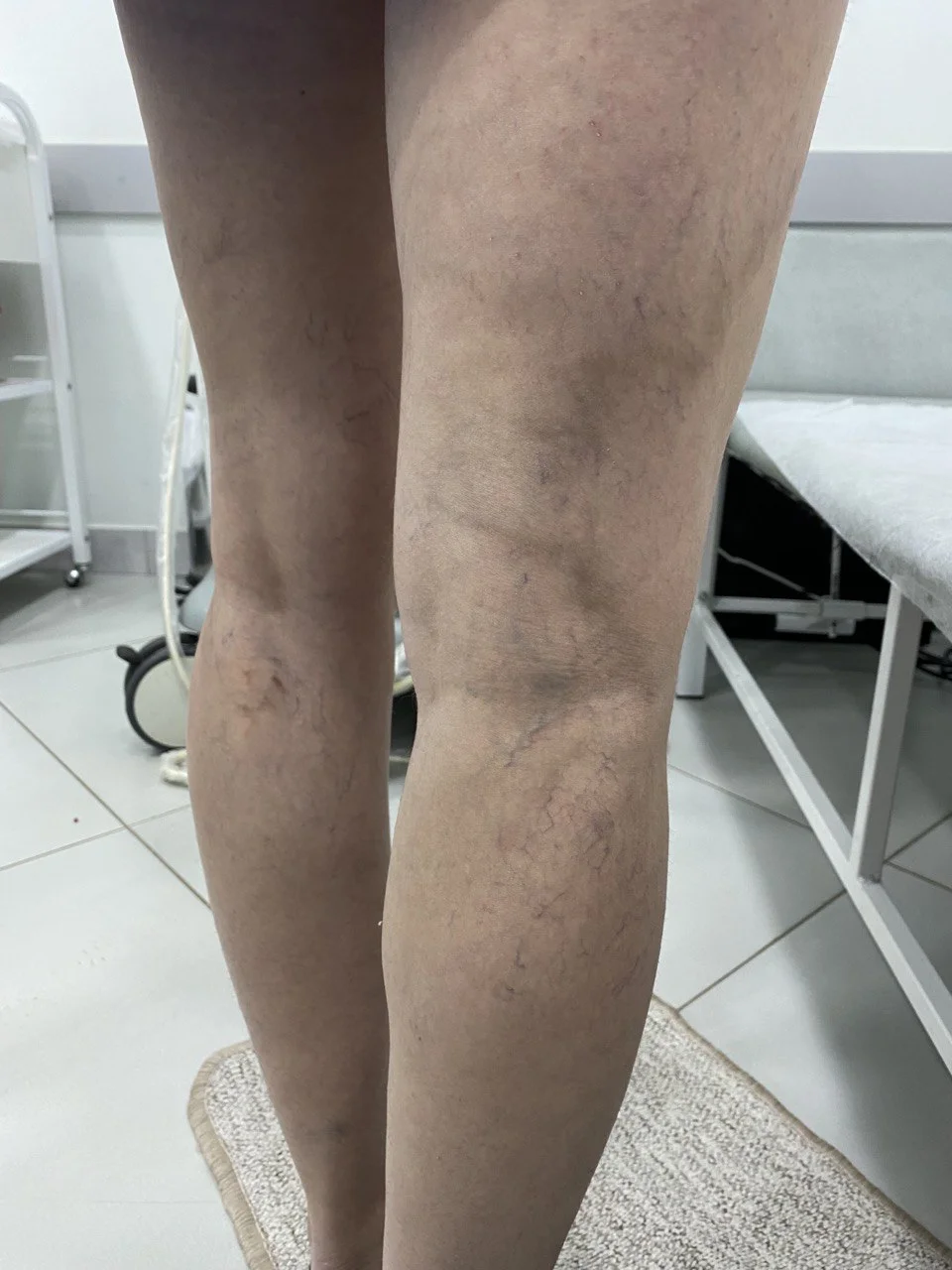 Переваги склеротерапії при лікуванні варикозу - Фото 7