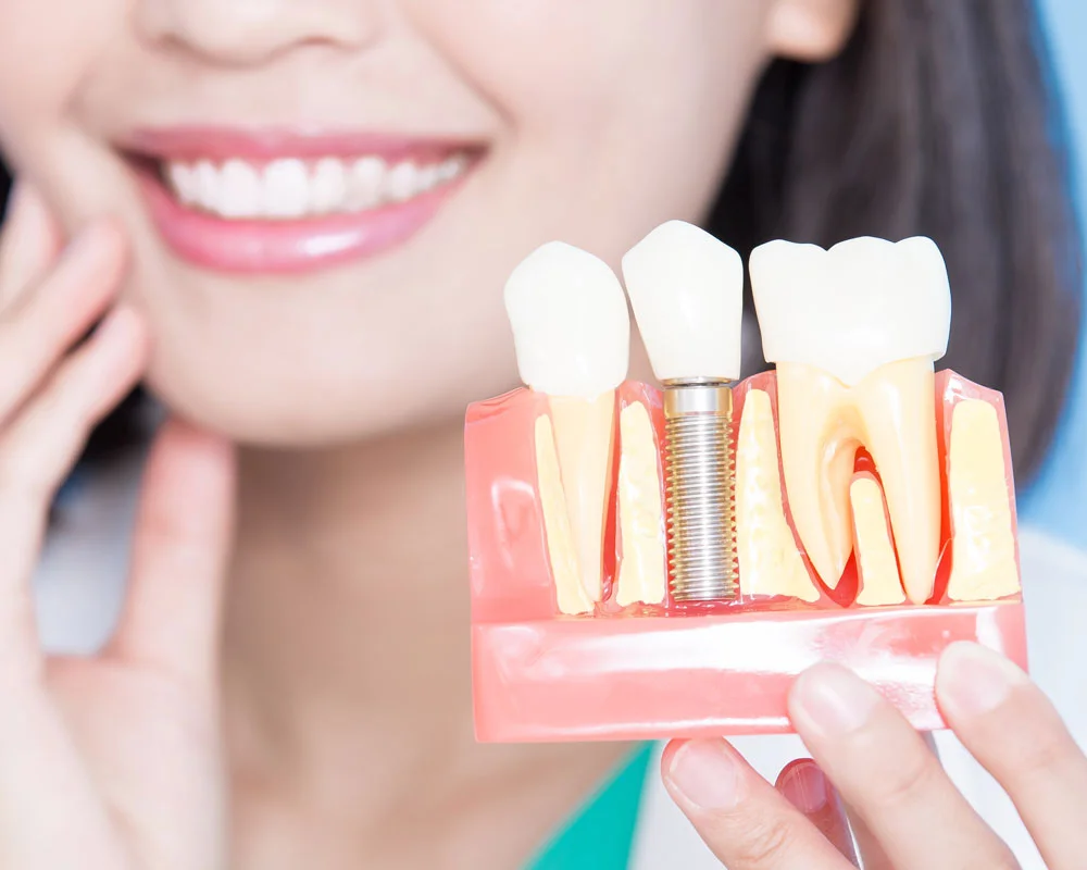 Імплантація зубів у Білій Церкві - Фото 3