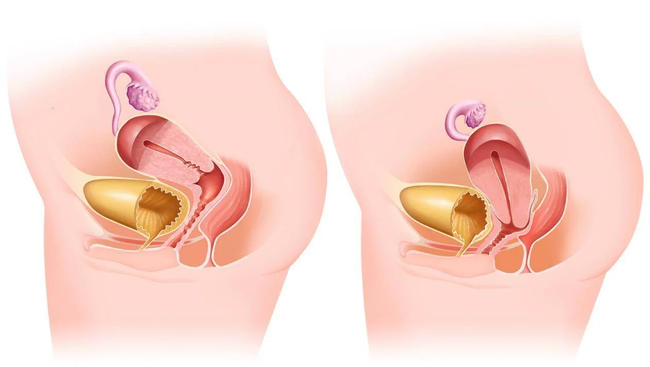 Лапароскопія пролапсу матки у Білій Церкві - Фото 4