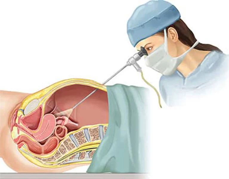 Лапароскопія пролапсу матки у Білій Церкві - Фото 5