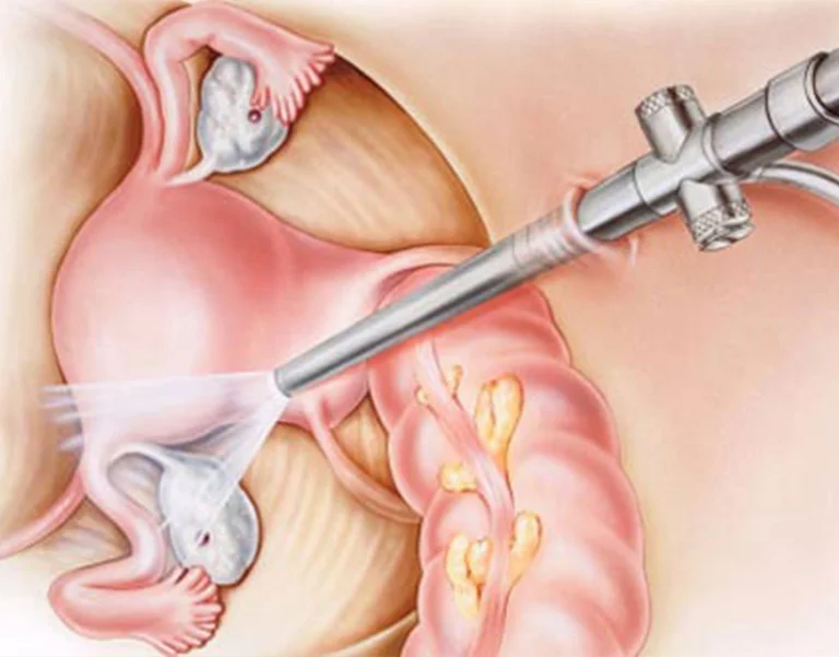 Лапароскопія пролапсу матки у Білій Церкві - Фото 6