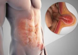 Лікування грижі в Білій Церкві - Фото 4