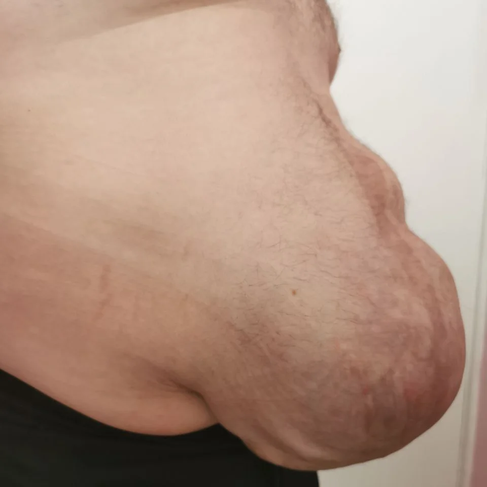 Лікування грижі в Білій Церкві - Фото 6