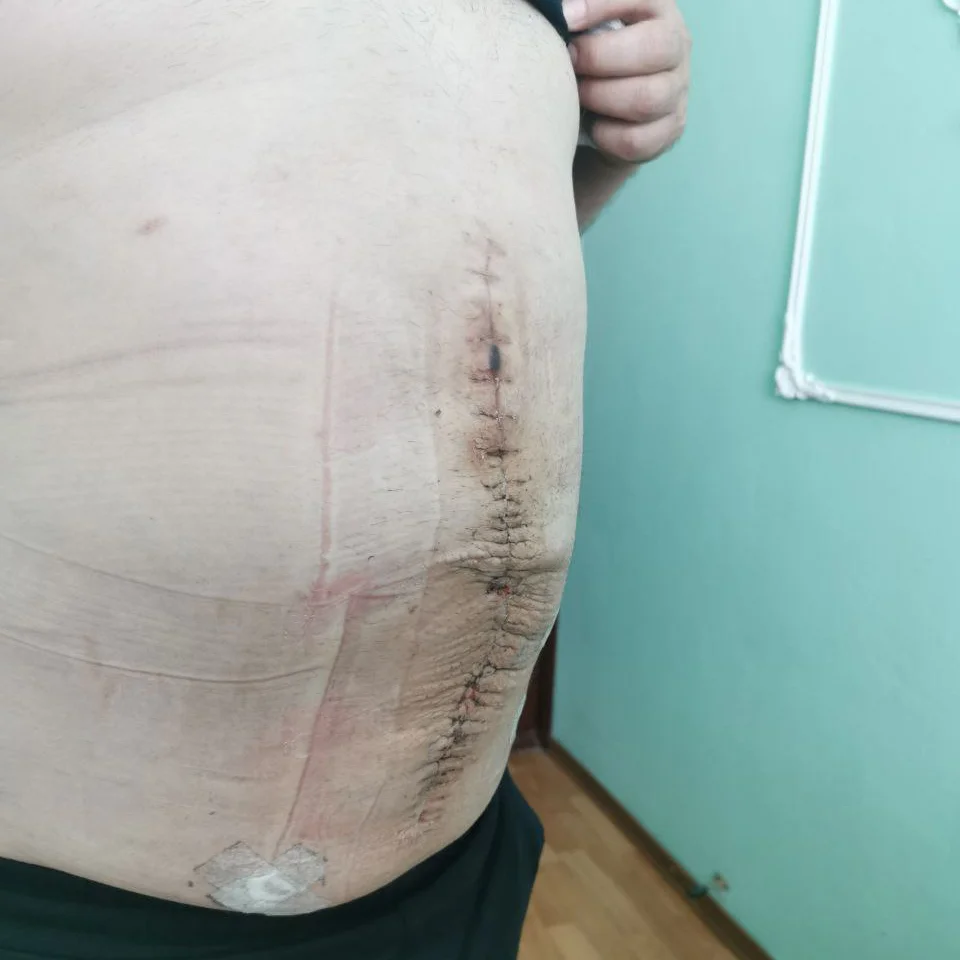 Лікування грижі в Білій Церкві - Фото 7