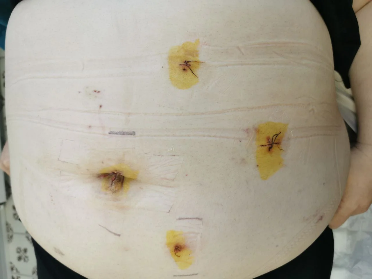 Лікування грижі в Білій Церкві - Фото 9