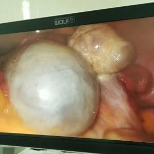 Кіста яєчника: види та лікування - Фото 4