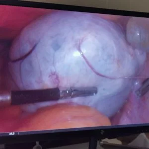 Кіста яєчника: види та лікування - Фото 5