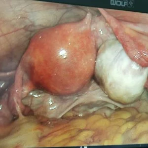 Кіста яєчника: види та лікування - Фото 6