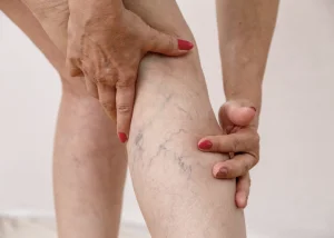 Методи лікування варикозу - Фото 5