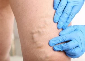 Методи лікування варикозу - Фото 4