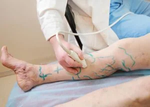 Методи лікування варикозу - Фото 6