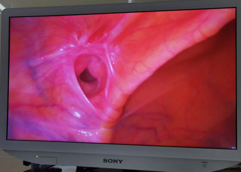 Переваги лапароскопічного методу лікування пахових гриж - Фото 4