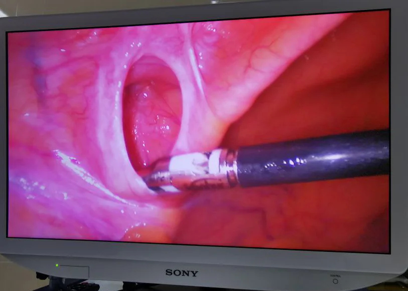 Переваги лапароскопічного методу лікування пахових гриж - Фото 6