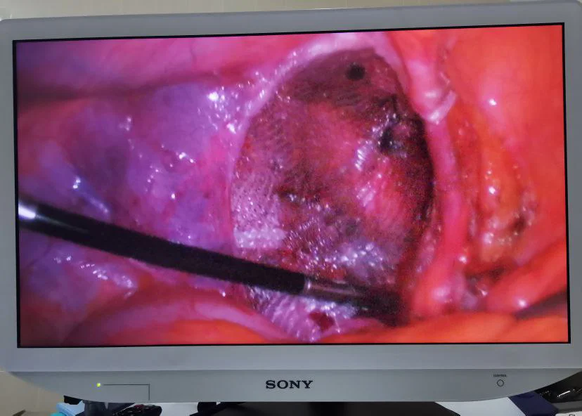 Переваги лапароскопічного методу лікування пахових гриж - Фото 5