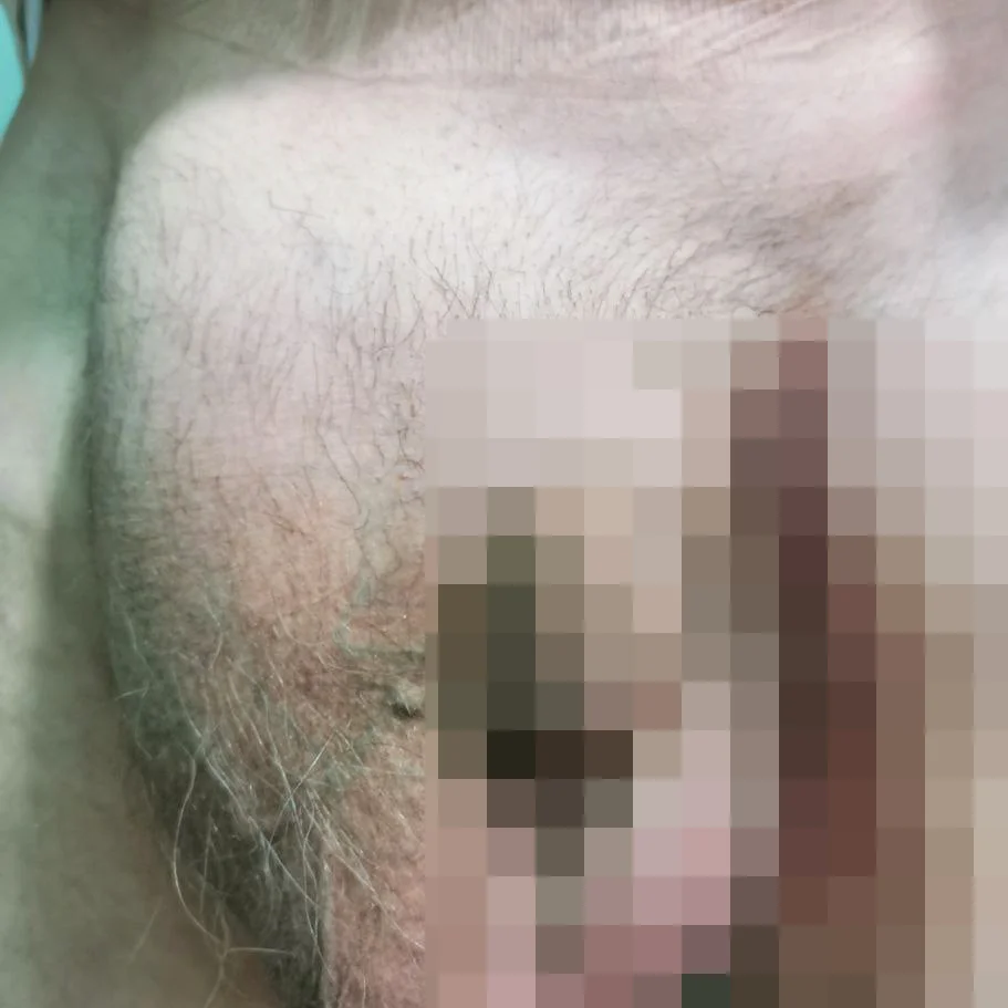 Переваги лапароскопічного методу лікування пахових гриж - Фото 7