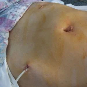 Кіста яєчника: як виявити та лікувати? - Фото 4