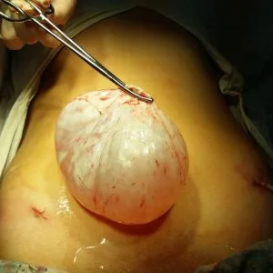 Кіста яєчника: як виявити та лікувати? - Фото 6